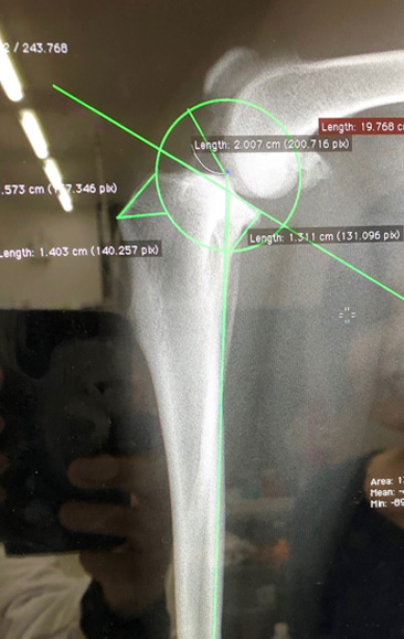 前十字靭帯断裂へのTPLO　術前X-ray