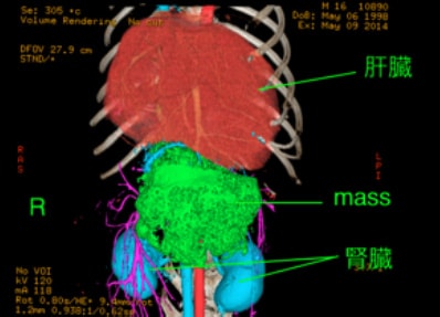 CT撮影時の腫瘍１