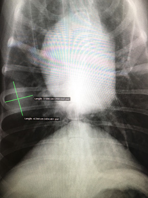 X-rayにて右肺中葉に孤立性のマス陰影を確認