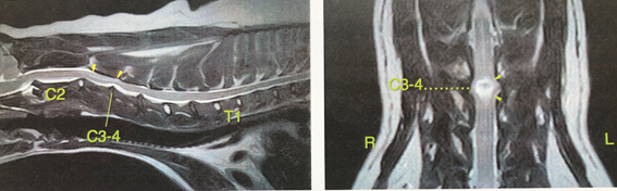 MRI撮影　第３、第４頚椎間において圧迫所見